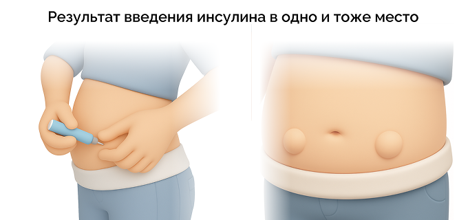 Принципы инсулинотерапии