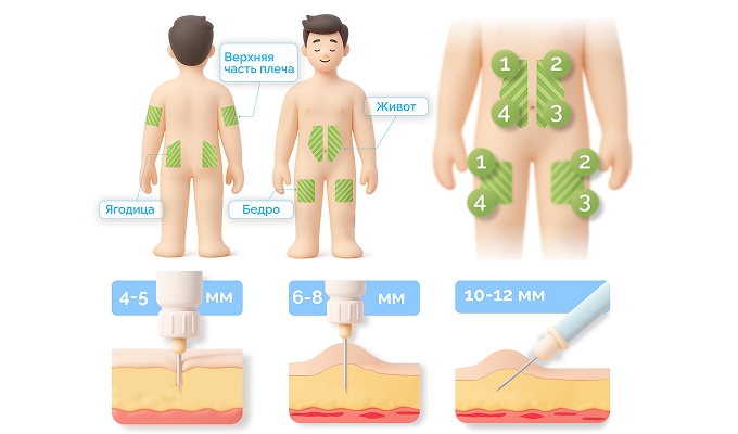 Ишемическая болезнь сердца (ИБС)