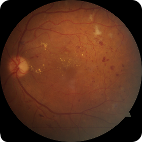 Диабетическая ретинопатия